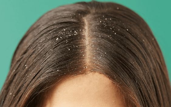 Make Use of Effective Dandruff Shampoo